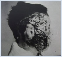 Yoshida prior to skin graft surgery