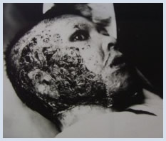 Yoshida after skin graft surgery, late 1946